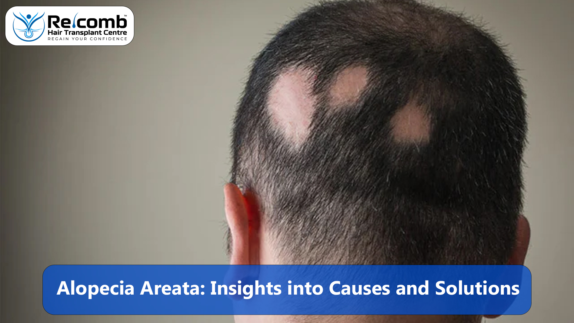 Alopecia_Areata_Insights_into_Causes_and_Solutions