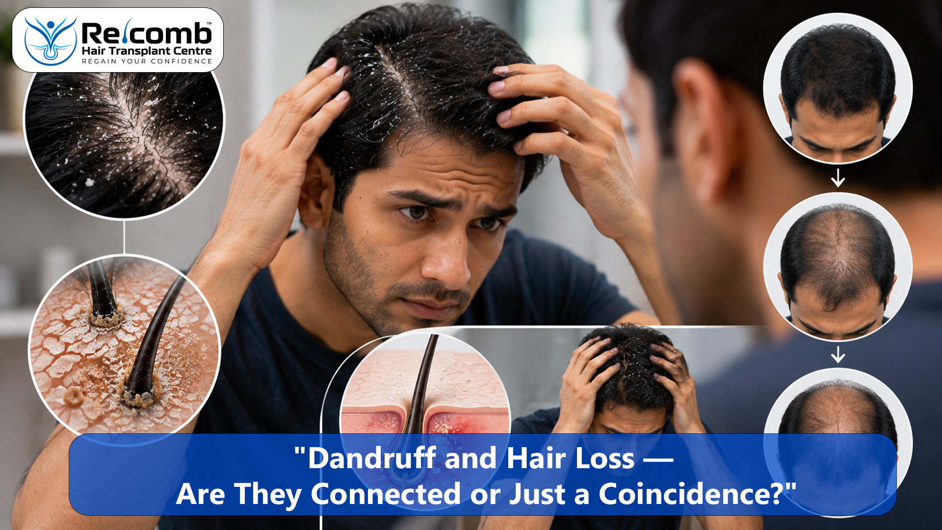 Dandruff_and_Hair_Loss_____Are_They_Connected_or_Just_a_Coincidence_copy Dandruff_and_Hair_Loss_____Are_They_Connected_or_Just_a_Coincidence_copy