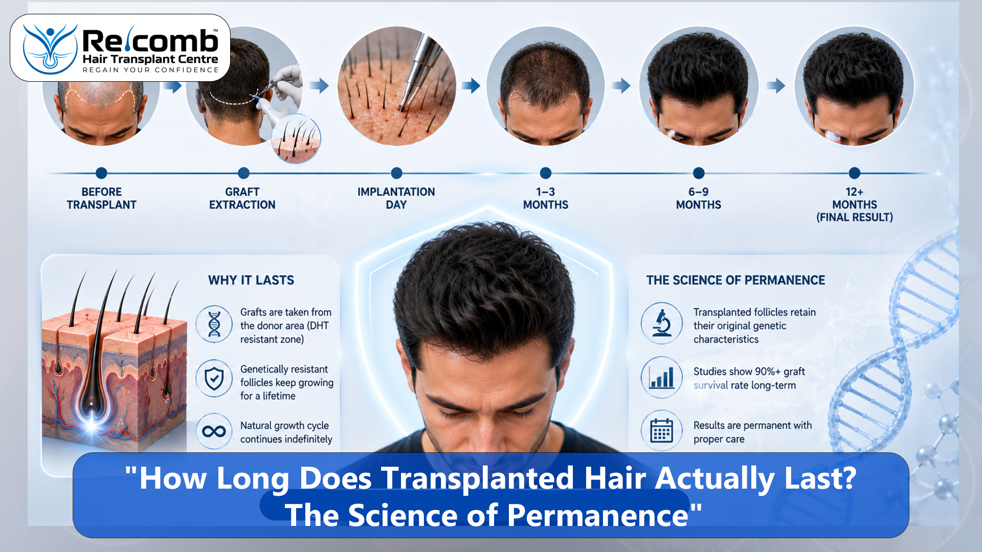 How_Long_Does_Transplanted_Hair_Actually_Last__The_Science_of_Permanence_copy How_Long_Does_Transplanted_Hair_Actually_Last__The_Science_of_Permanence_copy