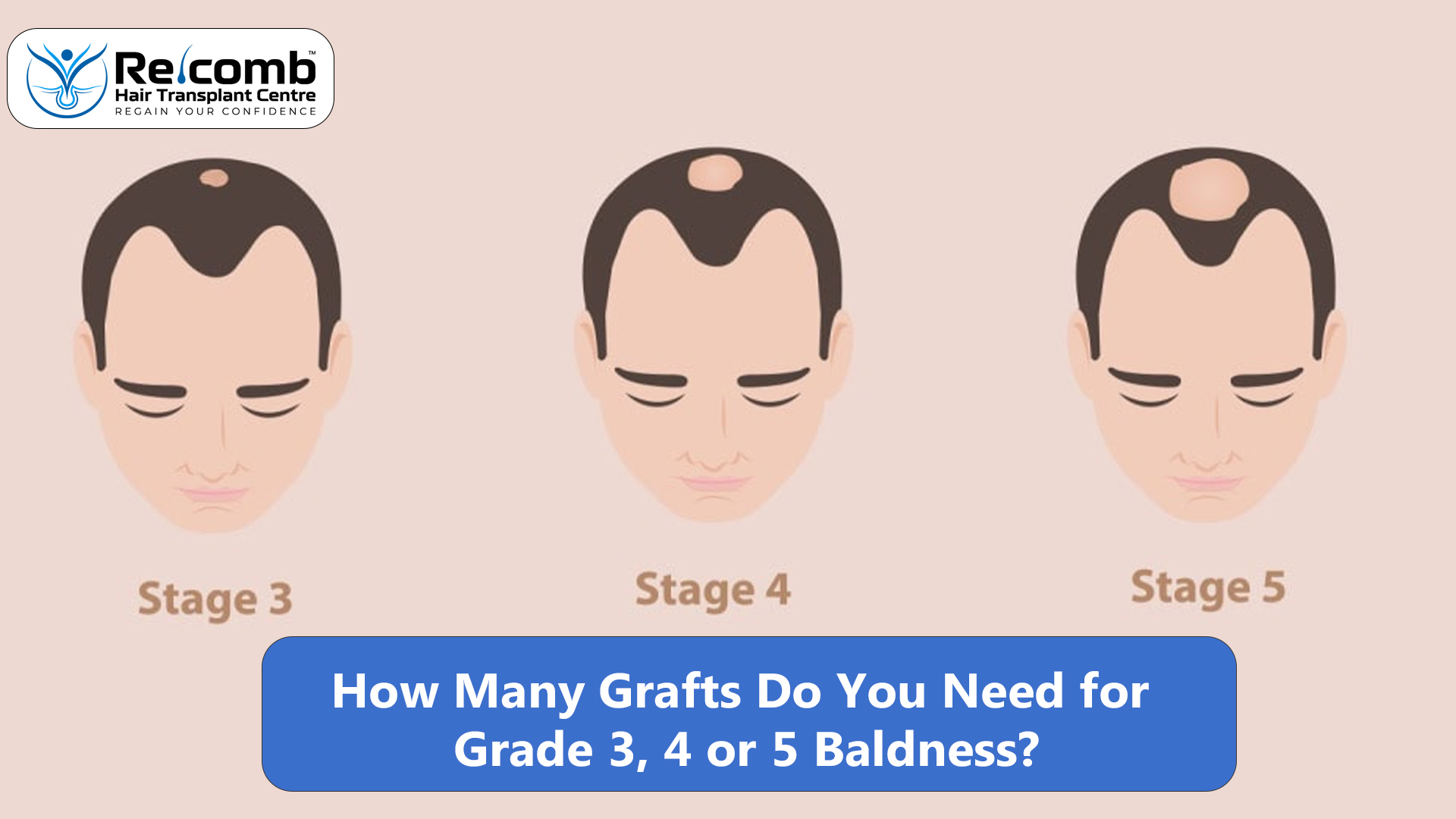 How_Many_Grafts_Do_You_Need_for_Grade_3__4_or_5_Baldness