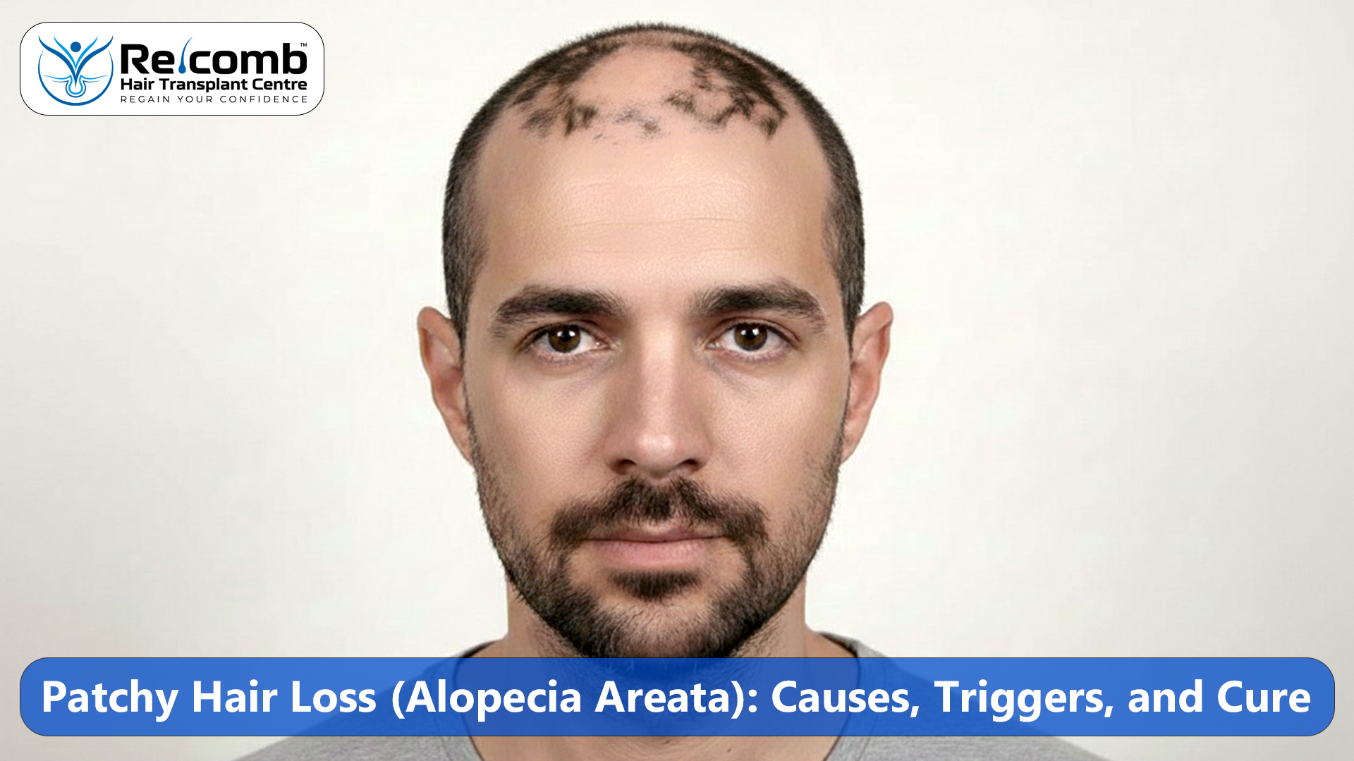 Patchy_Hair_Loss__Alopecia_Areata__Causes__Triggers__and_Cure
