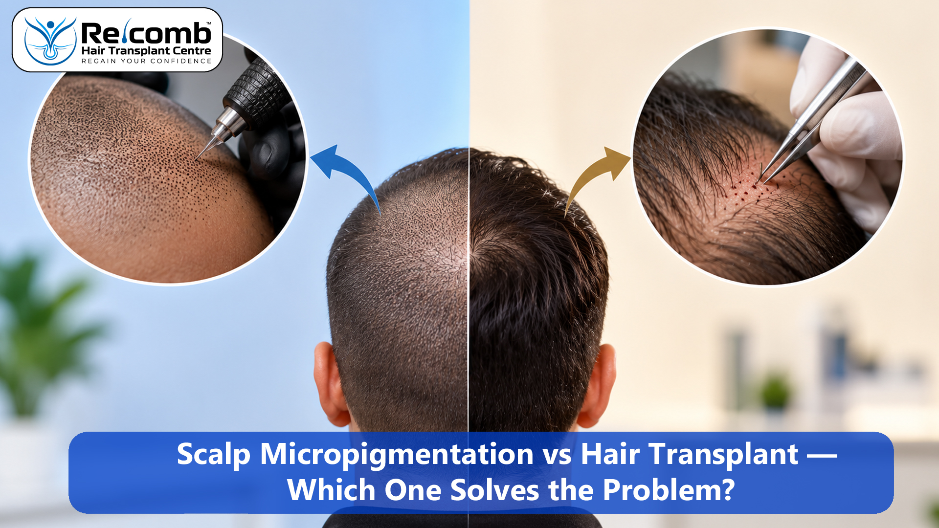 Scalp_Micropigmentation_vs_Hair_Transplant_____Which_One_Solves_the_Problem_ok_copy
