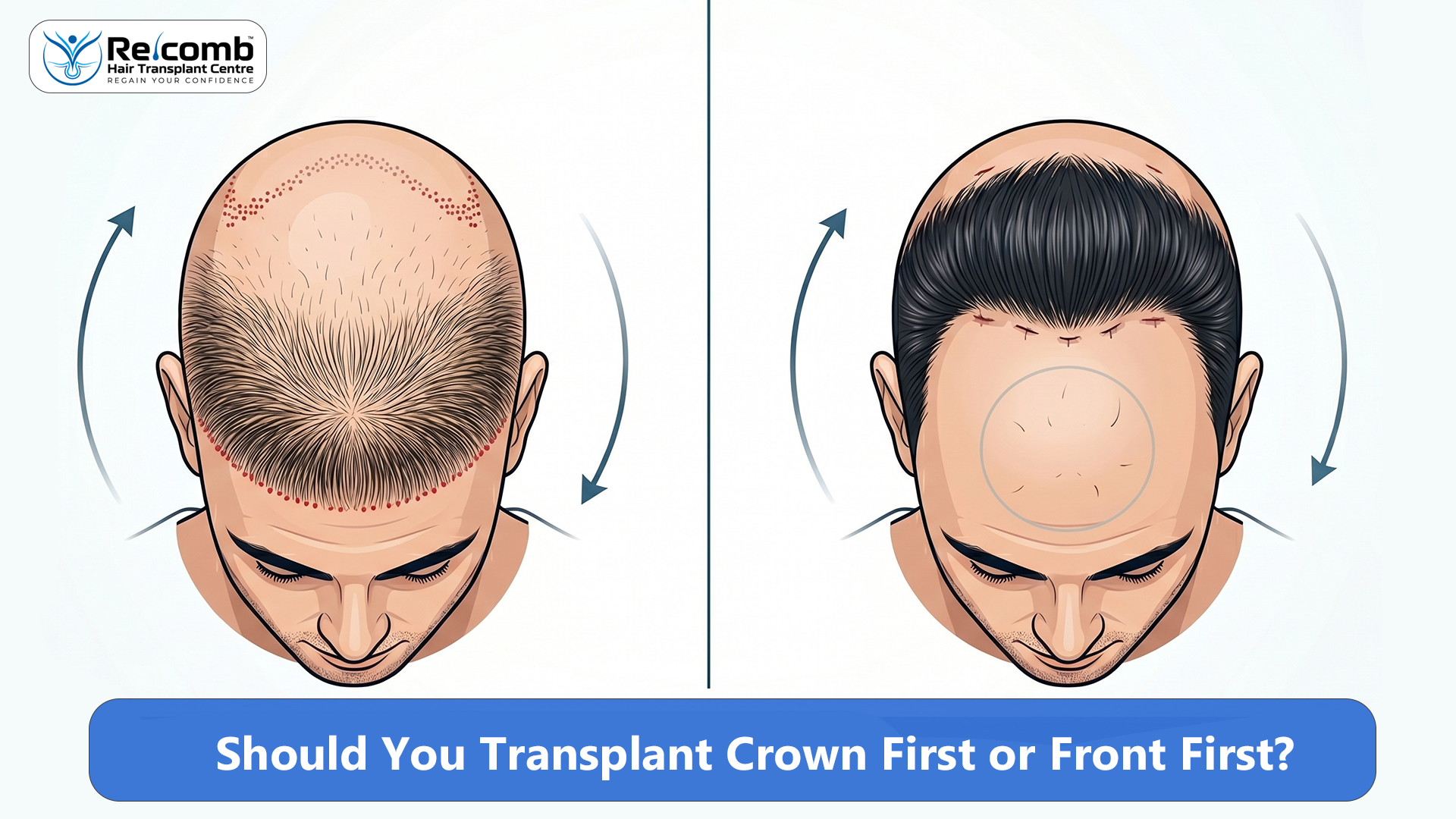Should_You_Transplant_Crown_First_or_Front_First