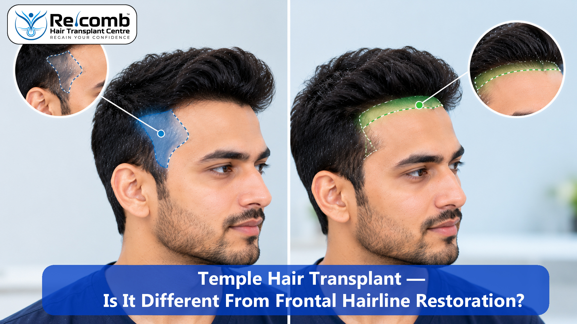Temple_Hair_Transplant_____Is_It_Different_From_Frontal_Hairline_Restoration_ok__copy