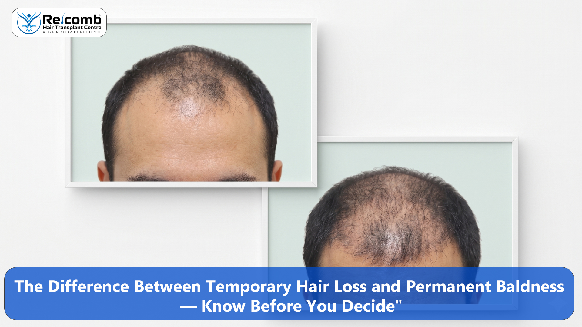 The_Difference_Between_Temporary_Hair_Loss_and_Permanent_Baldness_Know_Before_You_Decide The_Difference_Between_Temporary_Hair_Loss_and_Permanent_Baldness_Know_Before_You_Decide