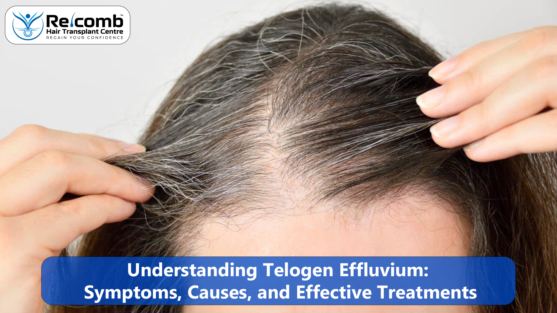 Understanding_Telogen_Effluvium_Symptoms__Causes__and_Effective_Treatments