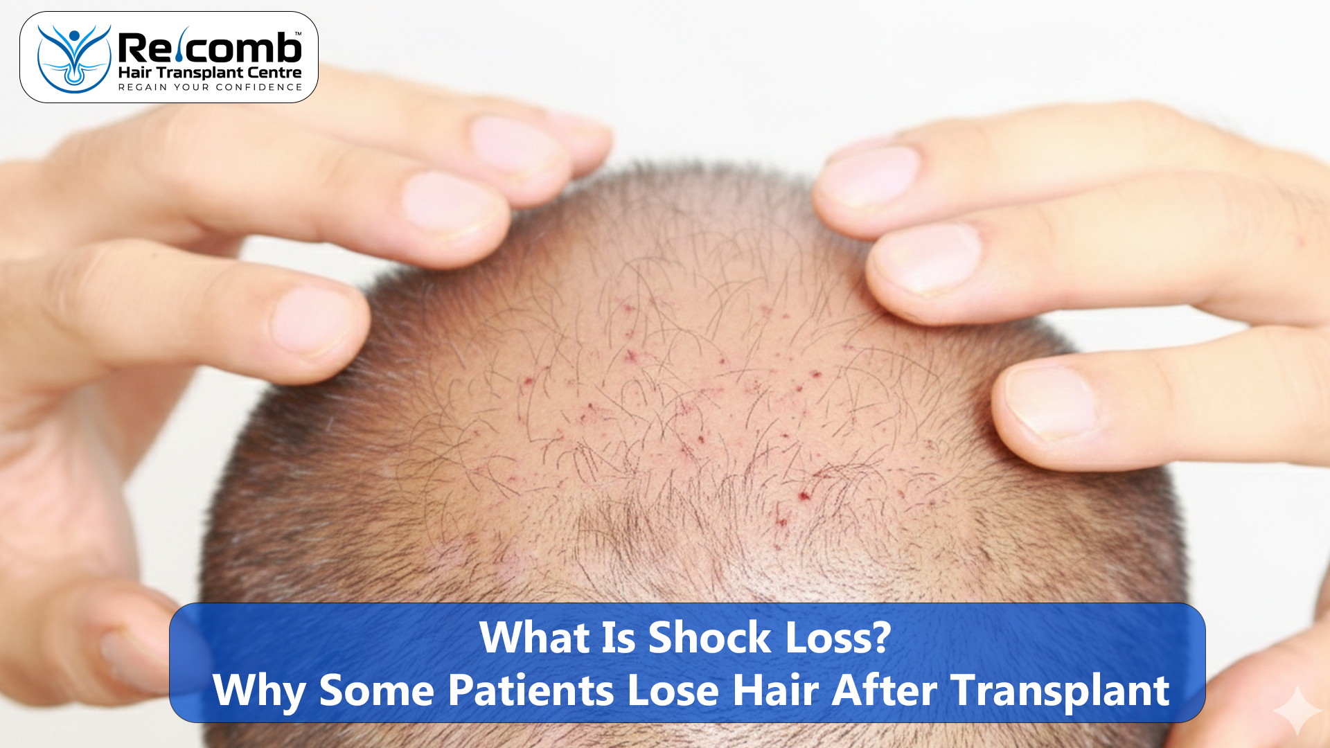 What_Is_Shock_Loss_Why_Some_Patients_Lose_Hair_After_Transplant
