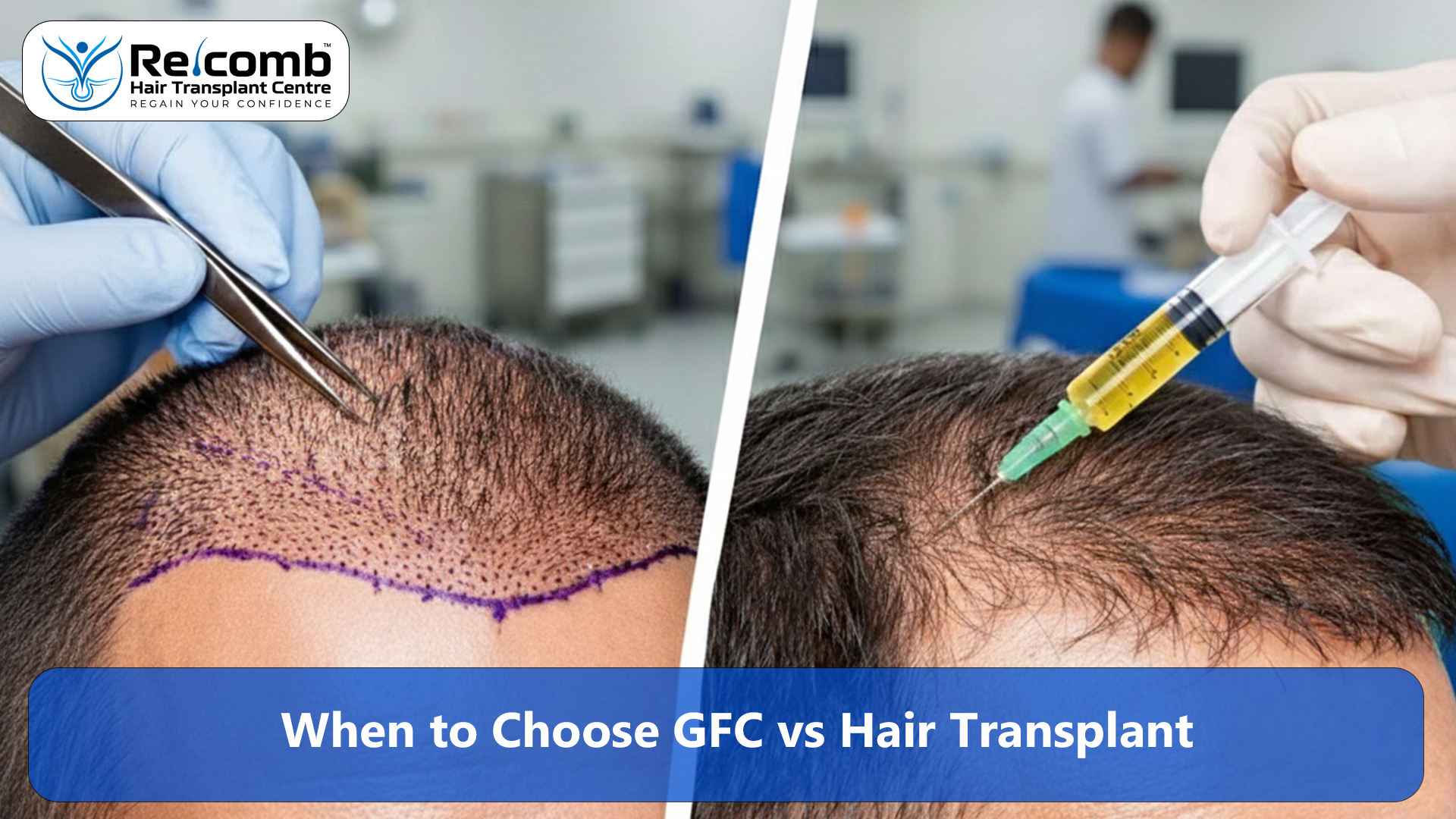 When_to_Choose_GFC_vs_Hair_Transplant