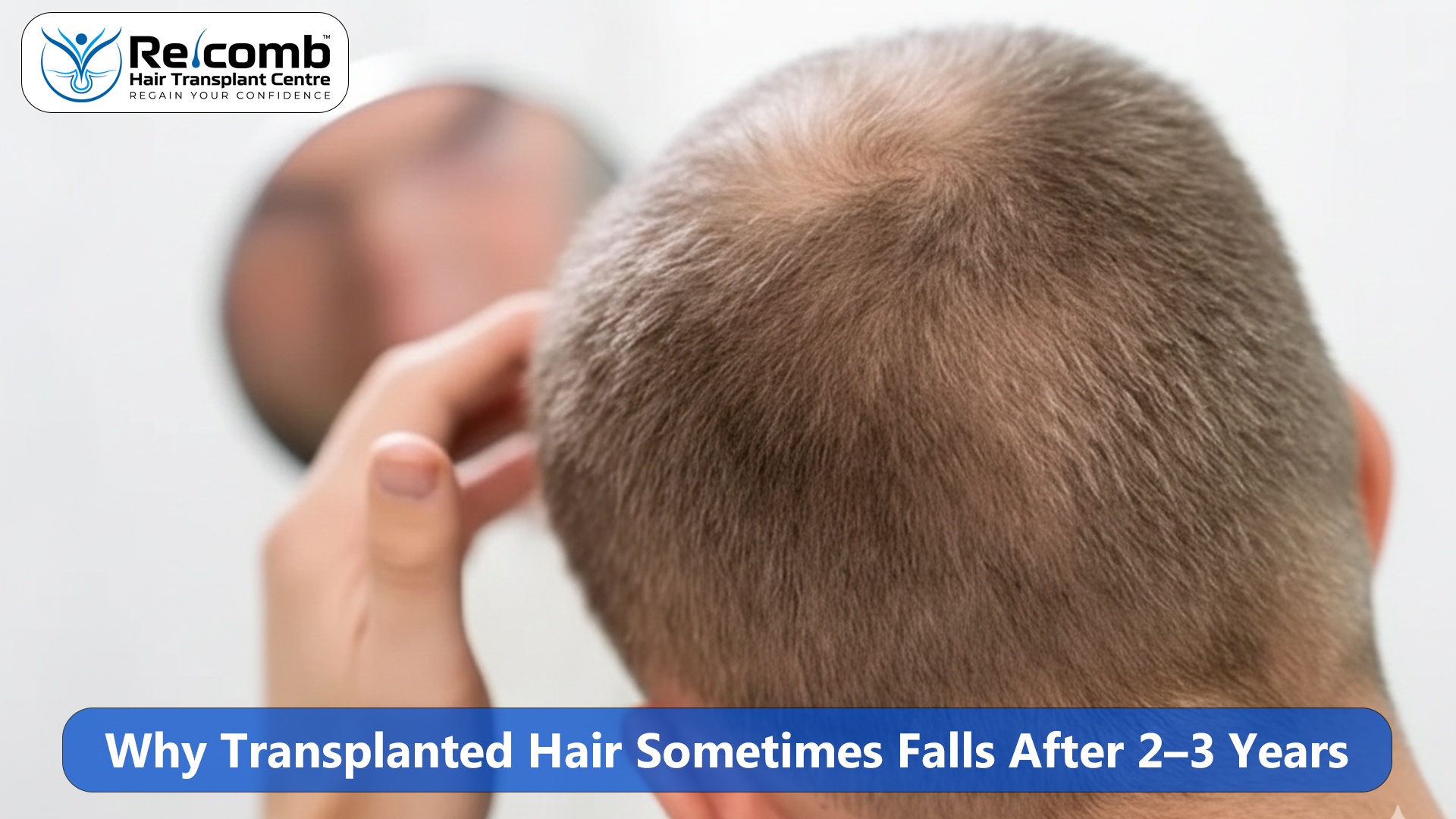Why_Transplanted_Hair_Sometimes_Falls_After_2___3_Years
