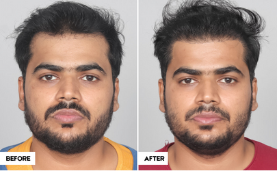 male-hair-transplant-before-after-surat